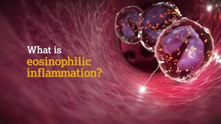 Thumbnail image of cells and airway inflammation with title ‘What is Eosinophilic inflammation?’