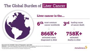 The Global Burden of Liver Cancer: Liver cancer is the 6th most common cancer worldwide, 3rd leading cause of cancer death, 5th most common cause of cancer deaths in men and 7th most common cause of cancer death in women.