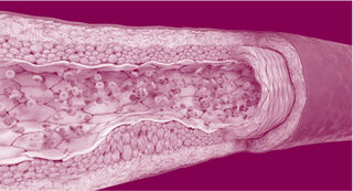 Visual of remnant dyslipidemia showing the inside of an artery filled with plaque