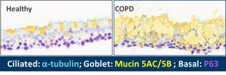 Oxidise IL-33 may be a driver of the mucus overproduction in COPD3